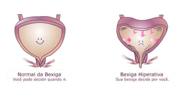 Bexiga Hiperativa